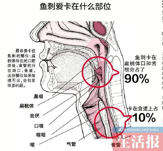 鱼刺卡在喉咙里几天后吞口水不痛感觉喉咙有异物这样鱼刺还在吗?